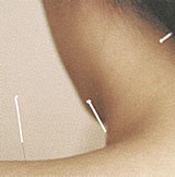 acupuncture needles